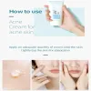 ACNE Cream