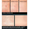 ACNE Cream